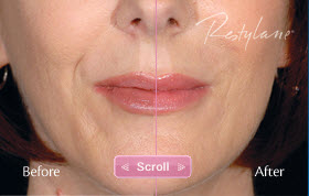 Juvederm® | Restylane® Hicksville NY