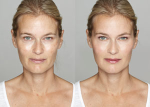 Sculptra® | Latisse® Hicksville NY